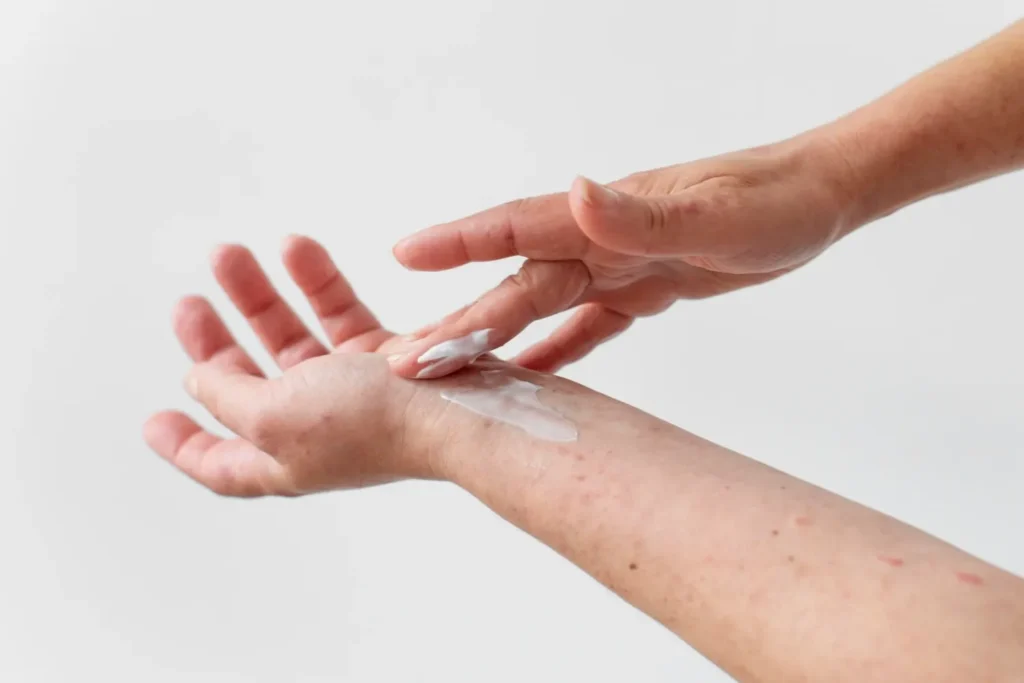 Maestría en Dermatitis Atópica y de Contacto y su Impacto Estético 2