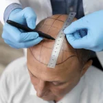 Maestría en Trasplante Capilar